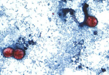 Disease Caused By Cyclospora Parasite Now In 45 States: CDC
